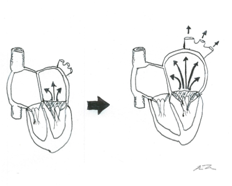 Degenerative valve disease heart image